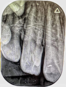 Figura 4. Radiografía periapical. Se observa una cámara pulpar única sin cuernos pulpares accesorios.
